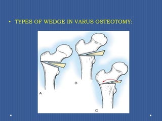 TYPES OF WEDGE IN VARUS OSTEOTOMY: