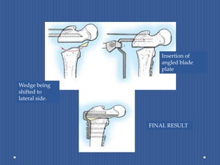 Insertion of angled blade plateWedge being shifted to lateral side.FINAL RESULT