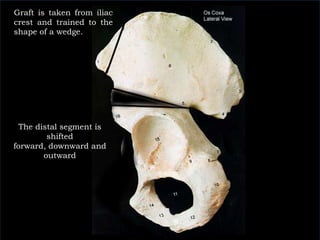 Graft is taken from iliac crest and trained to the shape of a wedge. The distal segment is shifted forward, downward and outward 