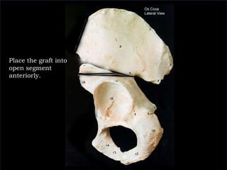 Place the graft into open segment anteriorly.