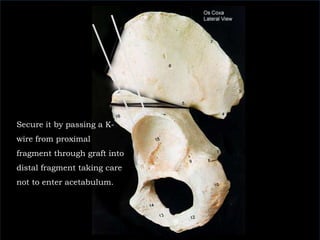 Secure it by passing a K-wire from proximal fragment through graft into distal fragment taking care not to enter acetabulum. 