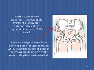 With a wide curved osteotome lever the distal fragment distally until anterior edges of two fragments is at least 2-3cm apart. Resect a wedge of bone from anterior part of ilium including ASIS. Place the wedge of bone in the groove made and drive the wedge into place and impact it. 