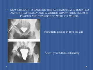 NOW SIMILAR TO SALTERS THE ACETABULUM IS ROTATED ANTERO-LATERALLY AND A WEDGE GRAFT FROM ILIUM IS PLACED AND TRANSFIXED WITH 2 K WIRES.Immediate post op in 16yr old girlAfter 1 yr of STEEL osteotomy