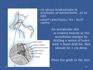 CE ANGLE IS MEASURED IN STANDING AP RADIOGRAPH ..AT 35 DEGGRAFT LENGTH(GL)= WA + SLOT DEPTHAn acetabular slotis created exactly at the acetabular margin by drilling a series of holes with 4.5mm drill bit. Slot should be 1 cm deep.Place the graft in the slot.