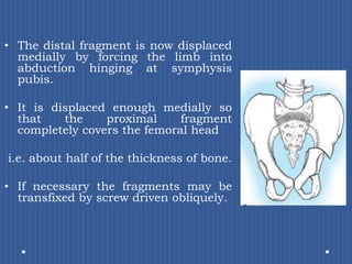 The distal fragment is now displaced medially by forcing the limb into abduction hinging at symphysis pubis. It is displaced enough medially so that the proximal fragment completely covers the femoral headi.e. about half of the thickness of bone. If necessary the fragments may be transfixed by screw driven obliquely.