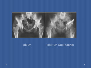             PRE OP 	POST  OP  WITH  CHIARI 
