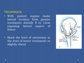 TECHNIQUE: With patient supine make lateral incision from greater trochanter distally 8 to 12cm exposing lateral aspect of femur. Mark the level of osteotomy at the level of lesser trochanter or slightly distal. 