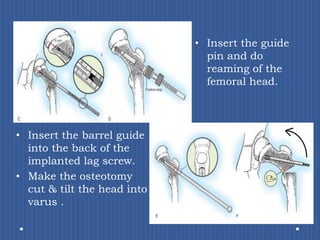 Insert the guide pin and do reaming of the femoral head.Insert the barrel guide into the back of the implanted lag screw.Make the osteotomy cut & tilt the head into varus .