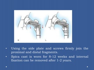 Using the side plate and screws firmly join the proximal and distal fragments. Spica cast is worn for 8-12 weeks and internal fixation can be removed after 1-2 years.