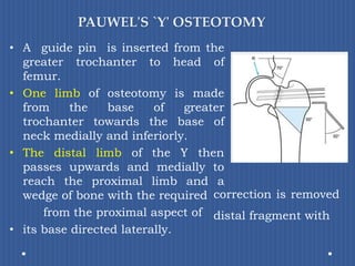 PAUWEL'S `Y' OSTEOTOMYA guide pin is inserted from the greater trochanter to head of femur. One limb of osteotomy is made from the base of greater trochanter towards the base of neck medially and inferiorly. The distal limb of the Y then passes upwards and medially to reach the proximal limb and a wedge of bone with the required           from the proximal aspect ofits base directed laterally. correction is removed distal fragment with