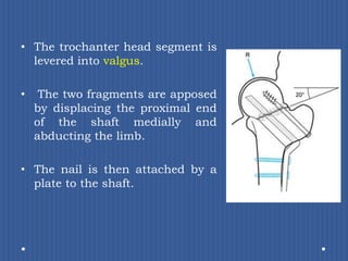 The trochanter head segment is levered into valgus. The two fragments are apposed by displacing the proximal end of the shaft medially and abducting the limb. The nail is then attached by a plate to the shaft.