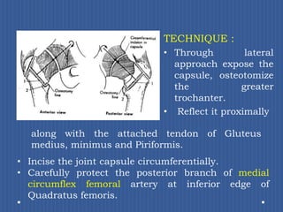 TECHNIQUE :Through lateral approach expose the capsule, osteotomize the greater trochanter.  Reflect it proximally along with the attached tendon of Gluteus medius, minimus and Piriformis. Incise the joint capsule circumferentially.