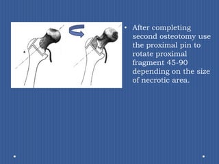 After completing second osteotomy use the proximal pin to rotate proximal fragment 45-90° depending on the size of necrotic area.