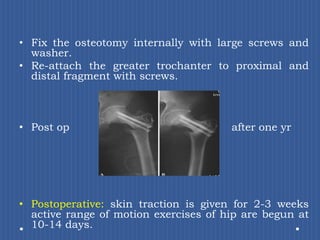 Fix the osteotomy internally with large screws and washer. Re-attach the greater trochanter to proximal and distal fragment with screws.Post op					      after one yrPostoperative:skin traction is given for 2-3 weeks active range of motion exercises of hip are begun at 10-14 days. 