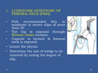 CUNEIFORM OSTEOTOMY OF FEMORAL NECK (FISH): Fish recommended this in moderate to severe slips of more than 30°. The hip is exposed through Watson-Jones incision. Capsule is incised & femoral neck is exposed. Locate the physis.Determine the size of wedge to be removed by noting the degree of slip. 