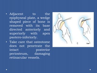 Adjacent to the epiphyseal plate, a wedge shaped piece of bone is removed with its base directed anteriorly and superiorly with apex psotero-inferiorly. Take care that osteotome does not penetrate the intact posterior periosteum, damaging retinacular vessels. 