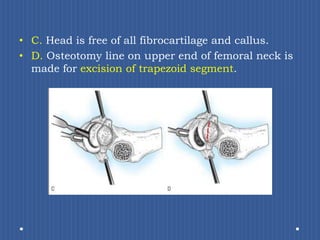 C.Head is free of all fibrocartilage and callus.D. Osteotomy line on upper end of femoral neck is made for excision of trapezoid segment.
