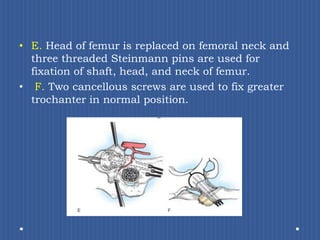 E. Head of femur is replaced on femoral neck and three threaded Steinmann pins are used for fixation of shaft, head, and neck of femur.F. Two cancellous screws are used to fix greater trochanter in normal position. 