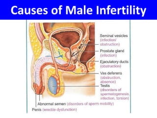 Causes of Male Infertility 
 
