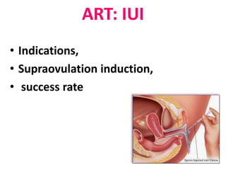 ART: IUI 
• Indications, 
• Supraovulation induction, 
• success rate 
 