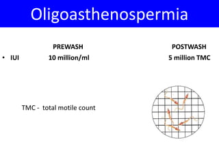 Oligoasthenospermia 
PREWASH 
• IUI 10 million/ml 
POSTWASH 
5 million TMC 
TMC - total motile count 
 