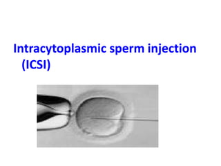 Intracytoplasmic sperm injection 
(ICSI) 
 