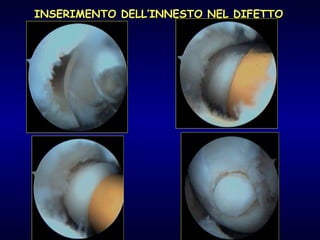 INSERIMENTO DELL’INNESTO NEL DIFETTO 