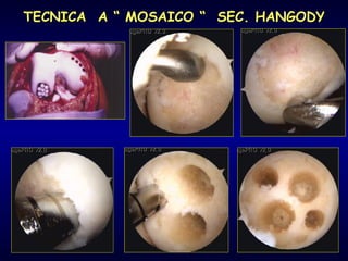TECNICA  A “ MOSAICO “  SEC. HANGODY 