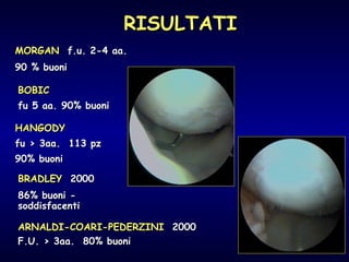 MORGAN   f.u. 2-4 aa. 90 % buoni BOBIC fu 5 aa. 90% buoni HANGODY fu > 3aa.  113 pz 90% buoni BRADLEY   2000  86% buoni - soddisfacenti ARNALDI-COARI-PEDERZINI   2000 F.U. > 3aa.  80% buoni RISULTATI 