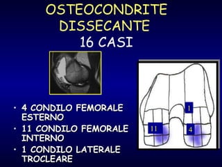 OSTEOCONDRITE DISSECANTE  16 CASI 4 CONDILO FEMORALE ESTERNO 11 CONDILO FEMORALE INTERNO 1 CONDILO LATERALE TROCLEARE 11  4 1 