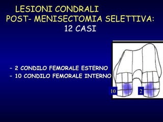 LESIONI CONDRALI  POST- MENISECTOMIA SELETTIVA:   12 CASI  2 CONDILO FEMORALE ESTERNO 10 CONDILO FEMORALE INTERNO 10 2 