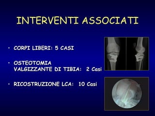 INTERVENTI ASSOCIATI CORPI LIBERI: 5 CASI OSTEOTOMIA  VALGIZZANTE DI TIBIA:  2 Casi RICOSTRUZIONE LCA:  10 Casi 