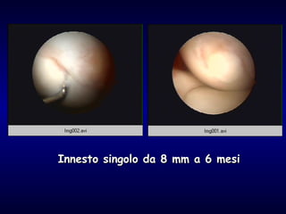 Innesto singolo da 8 mm a 6 mesi 