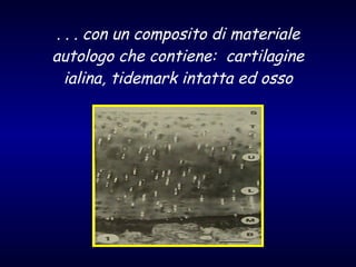 . . . con un composito di materiale autologo che contiene:  cartilagine ialina, tidemark intatta ed osso 