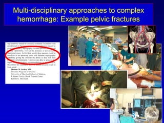 Multi-disciplinary approaches to complex
hemorrhage: Example pelvic fractures
 