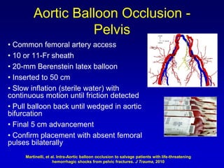 • Common femoral artery access
• 10 or 11-Fr sheath
• 20-mm Berenstein latex balloon
• Inserted to 50 cm
• Slow inflation (sterile water) with
continuous motion until friction detected
• Pull balloon back until wedged in aortic
bifurcation
• Final 5 cm advancement
• Confirm placement with absent femoral
pulses bilaterally
Aortic Balloon Occlusion -
Pelvis
Martinelli, et al. Intra-Aortic balloon occlusion to salvage patients with life-threatening
hemorrhagic shocks from pelvic fractures. J Trauma, 2010
 