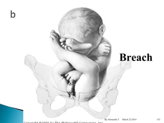 Breach 
By Alemyehu T March 22-2014 
153 
 