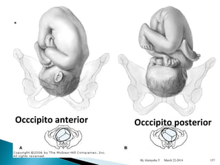 Occcipito anterior Occcipito posterior 
By Alemyehu T March 22-2014 
157 
 