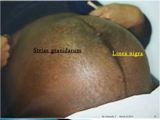 Striae gravidarum Linea nigra 
By Alemyehu T March 22-2014 
52 
 
