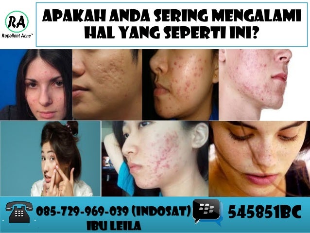 OBAT JERAWAT AMPUH TERBAIK, OBAT JERAWAT AMPUH DALAM SEMALAM, dan OBA…