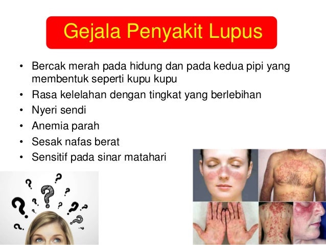 How Lupus Affects The Gastrointestinal System Lupus How Lupus Affects The Gastrointestinal System Lupus