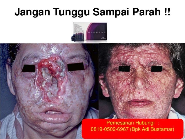 0819 0502 6967 Xl Penyakit Lupus Menular Penyakit Menular Penyeb