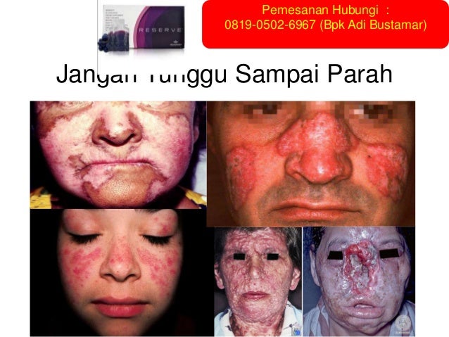 0819 0502 6967 Xl Penyakit Lupus Menular Penyakit Menular Penyeb
