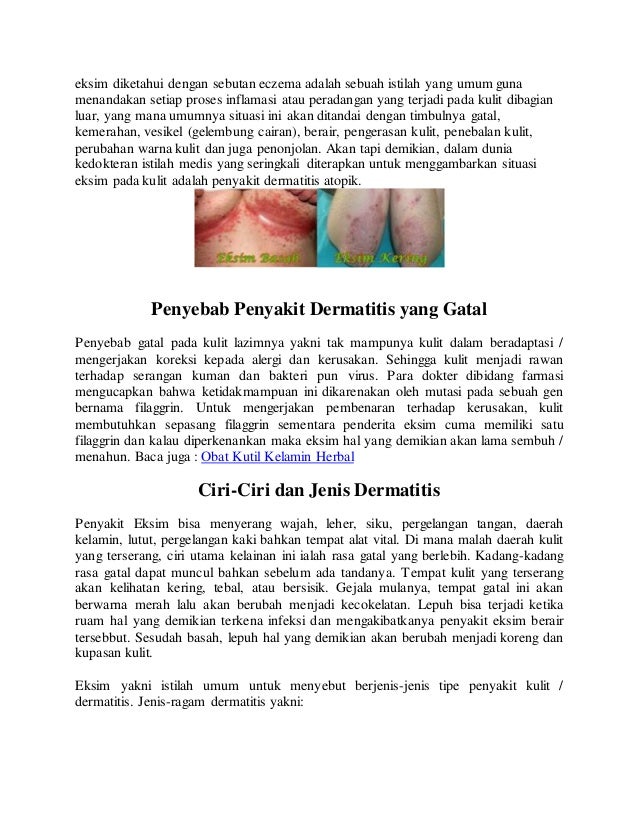Cara Menghilangkan Eksim Basah