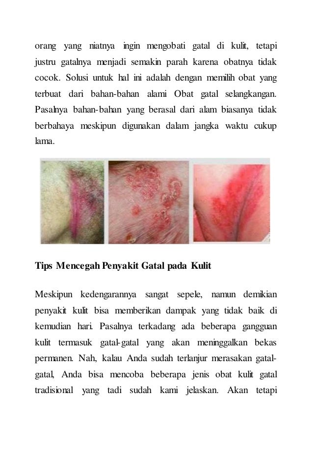Cara Mengatasi Gatal Pada Selangkangan Dengan Alami