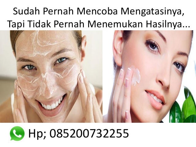 0852-0073-2255, Obat jerawat ampuh cepat berkhasiat