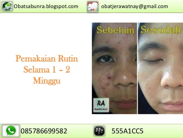 0857 8669 9582 Obat Jerawat Di Apotik