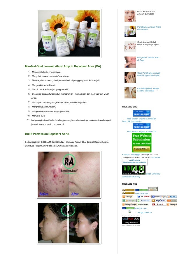 SMS 0856 4369 9889, Obat Jerawat Punggung di Apotik