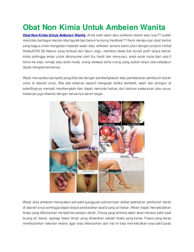 Obat non kimia untuk ambeien wanita Obat non kimia untuk ambeien wanita