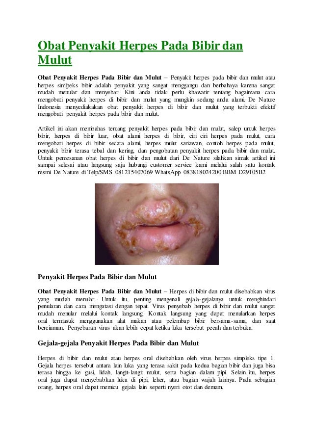 Obat Penyakit Herpes Pada Bibir Dan Mulut